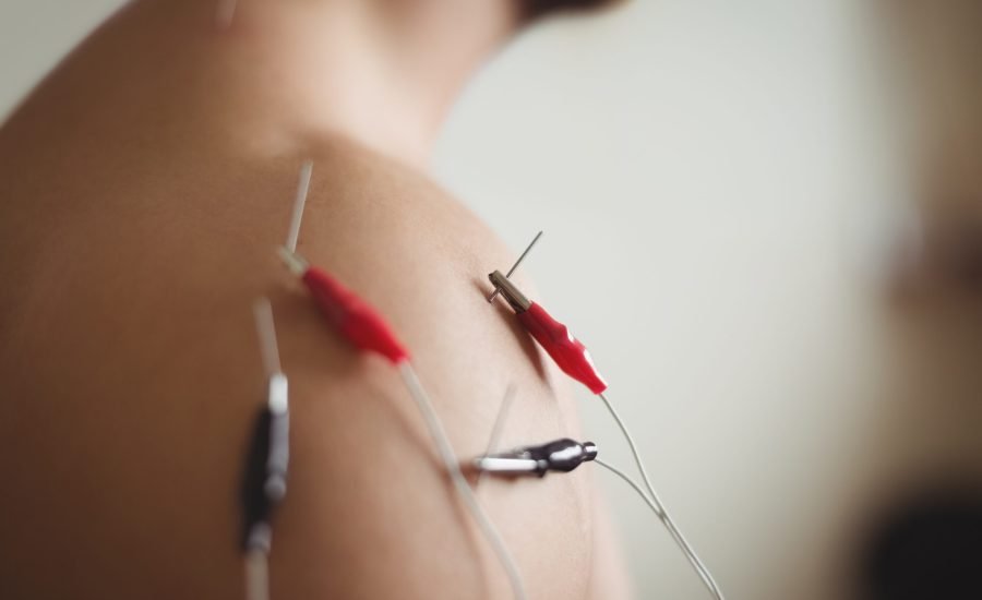 Close-up of patient getting electro dry needling on shoulder